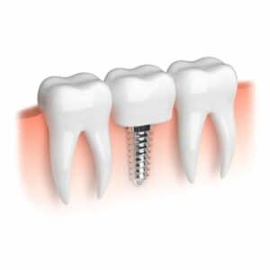 Making You Smile Dental Implants In New York City