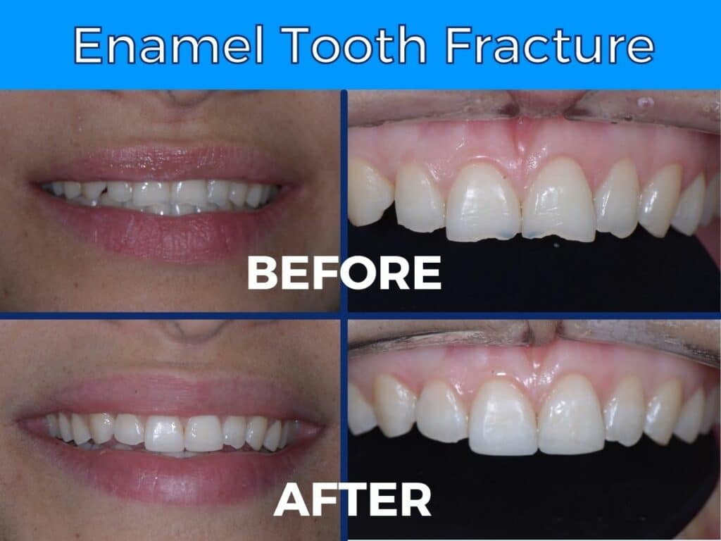 Making You Smile Enamel Fracture Before And After