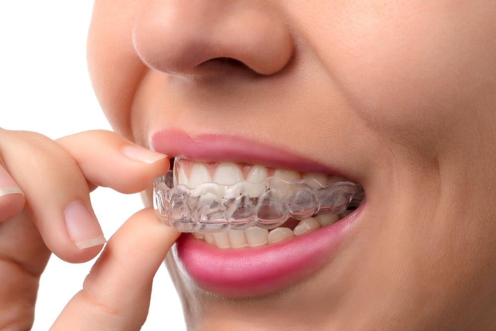 Affordable Invisalign NYC - Invisalign Cost NYC - Guide On How Much Does  Invisalign Cost in NYC? - Get Invisalign Near You - Invisalign Braces Teeth  Straightening- Making You Smile