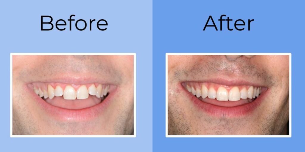 AtHome Aligners Making You Smile NYC