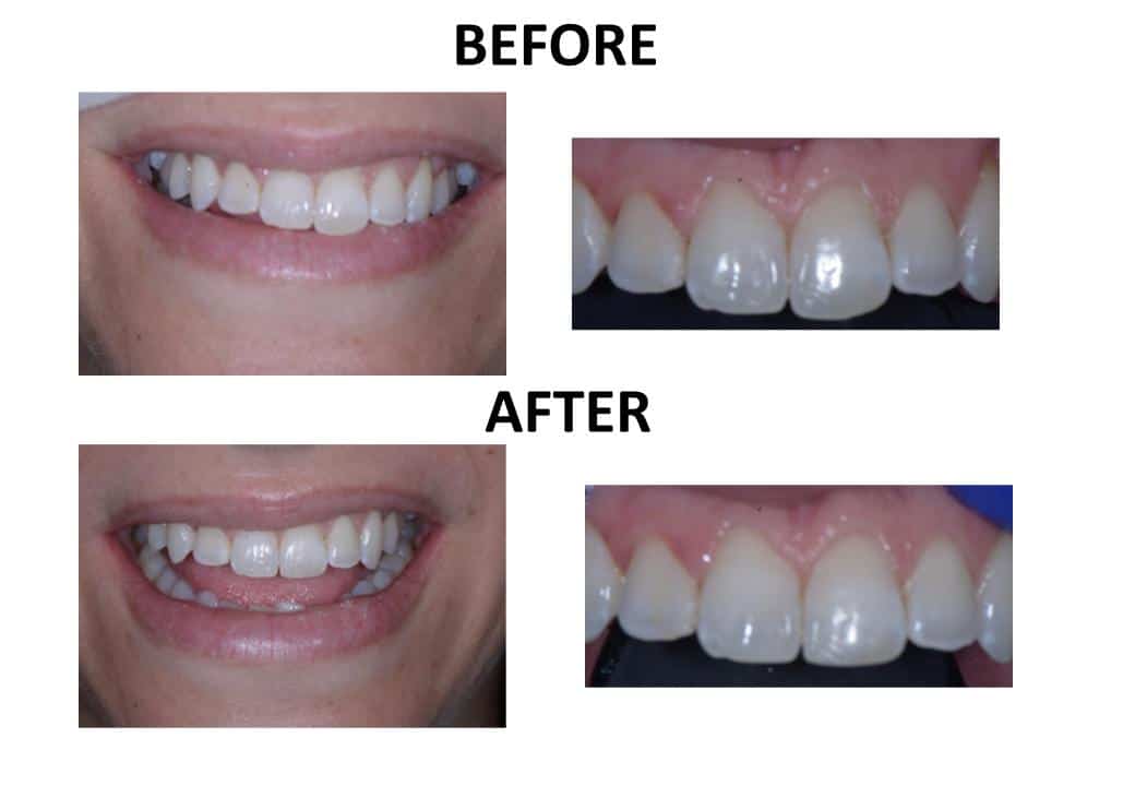 Tooth Recontouring 2