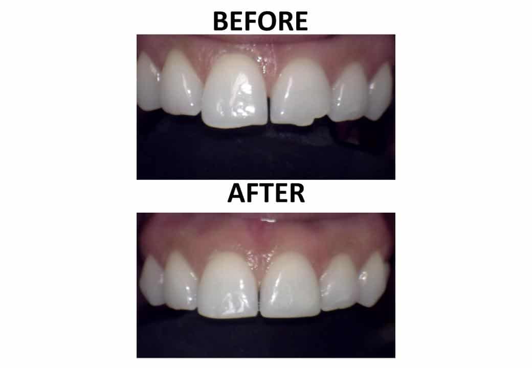 Tooth Recontouring 3