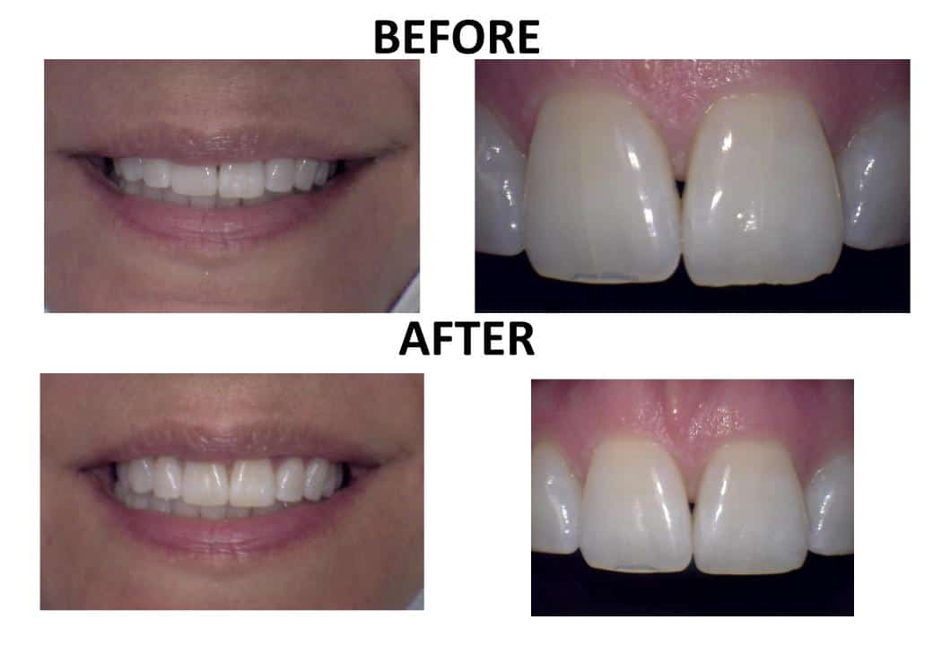 Tooth Recontouring 4