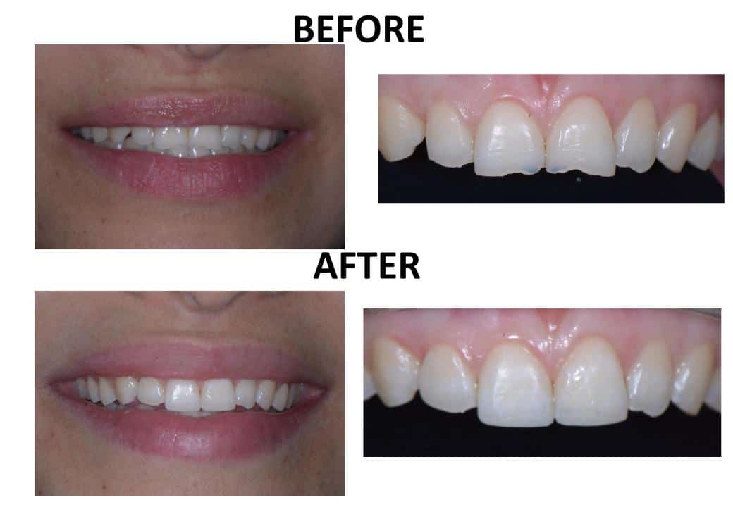 Tooth Recontouring 5