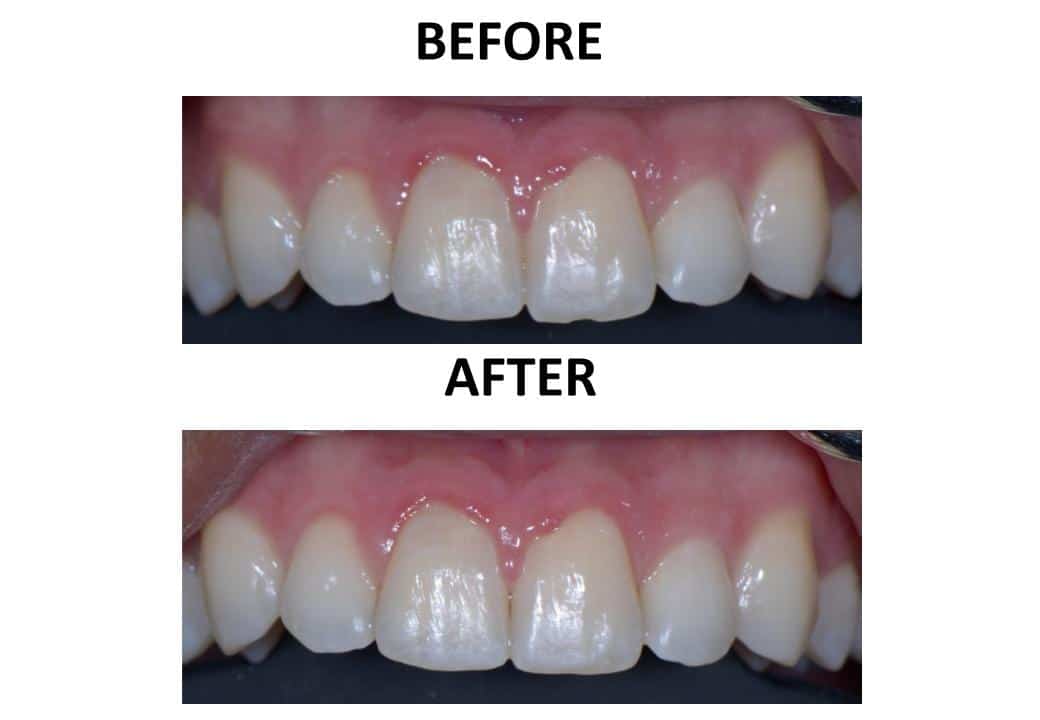 Tooth Recontouring