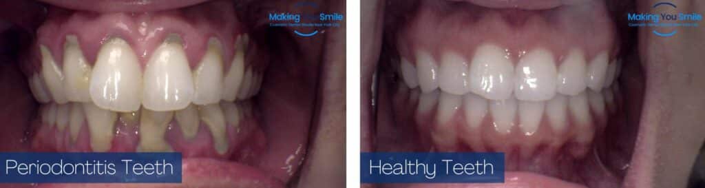 Making You Smile Periodontitis Teeth VS Healthy Teeth