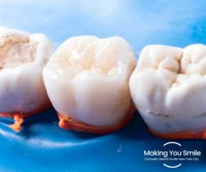 Mys White Teeth Fillings New York Dental Clinic2